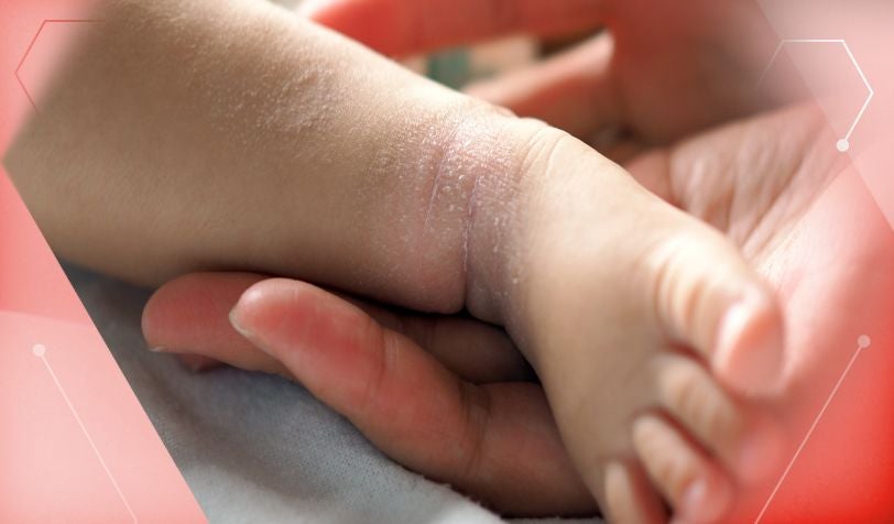 Ein Baby mit Ausschlam Körper aufgrund einer Kuhmilchallergie; faelschlicher Verdacht auf Erdnussallergie.