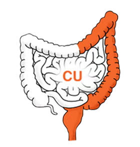 Colitis ulcerosa (CU)